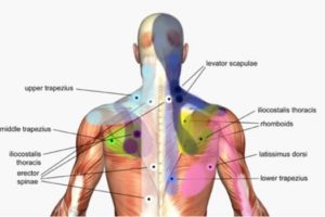 Trigger Point Injections Encinitas, CA - Muscle Pain Treatments